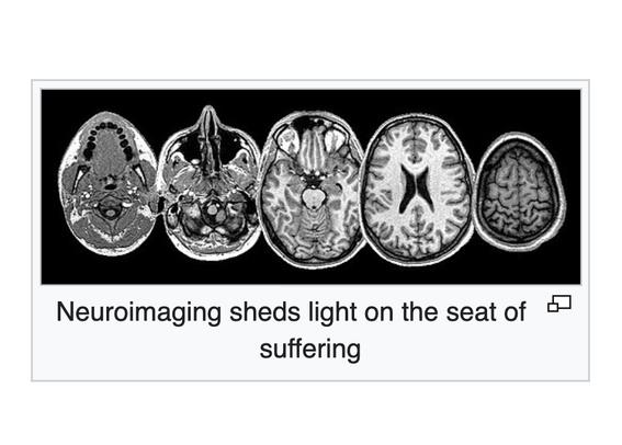 Neuroimaging sheds light on the seat of suffering