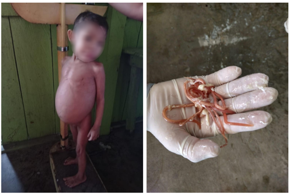 On the left, a Yanomami child with a noticeably distended abdomen due to intestinal worms. On the right, a hand wearing a surgical glove shows several worms.
(Photo: Reproduced from MPF)